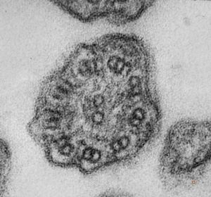 F,5y. | immotile cilia syndrome - nasal mucosa F,5y. | immotile cilia syndrome - nasal mucosa